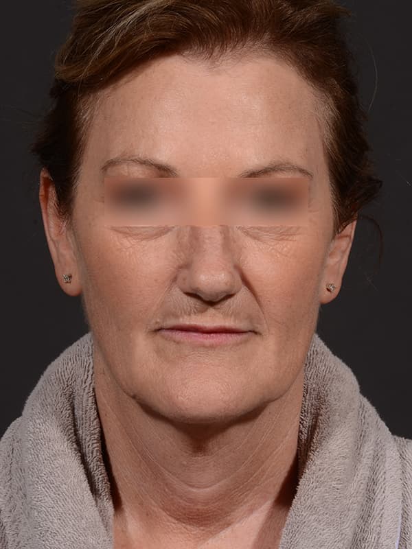 Face and Neck Lift Before & After Image