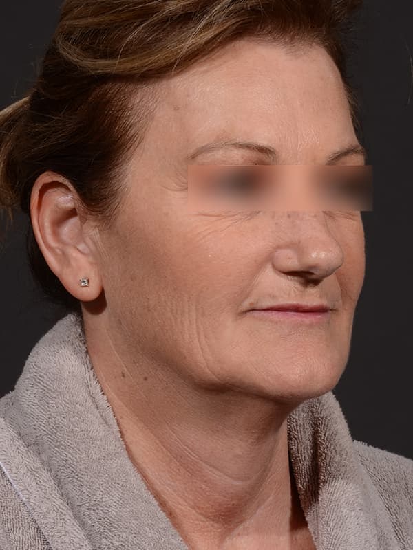 Face and Neck Lift Before & After Image