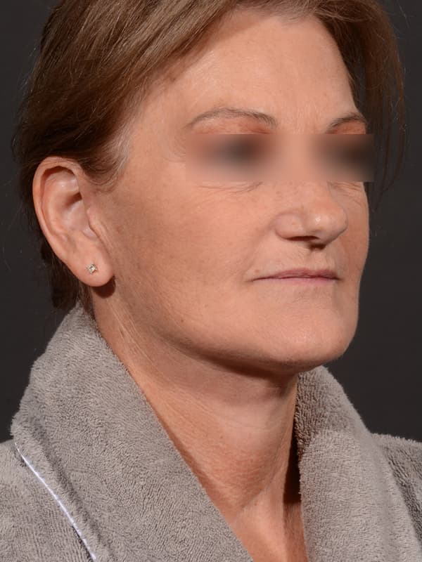 Face and Neck Lift Before & After Image