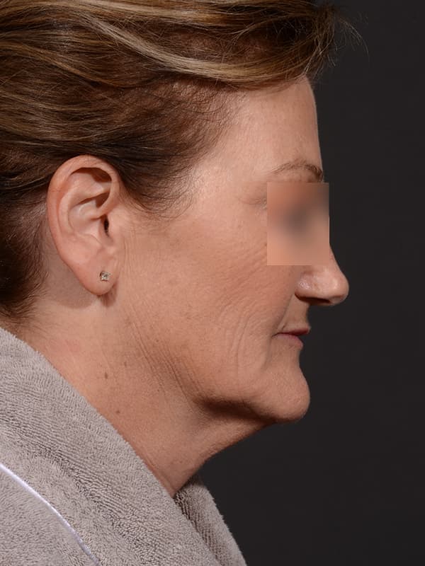 Face and Neck Lift Before & After Image