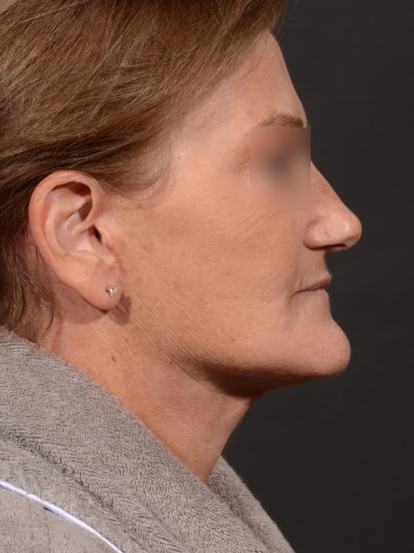 Face and Neck Lift Before & After Image