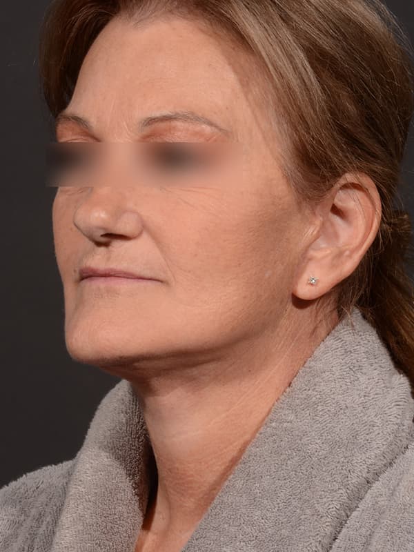 Face and Neck Lift Before & After Image