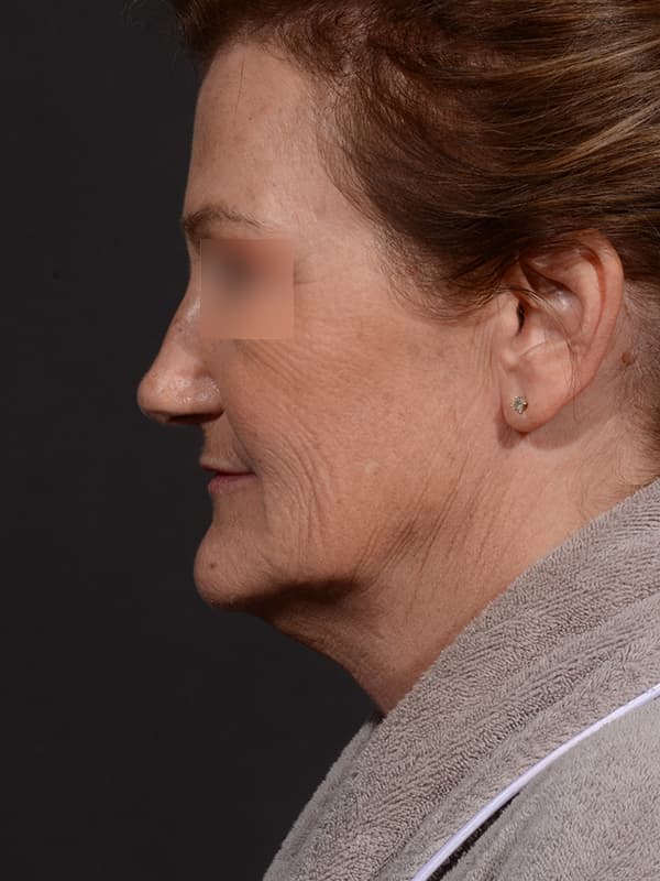 Face and Neck Lift Before & After Image