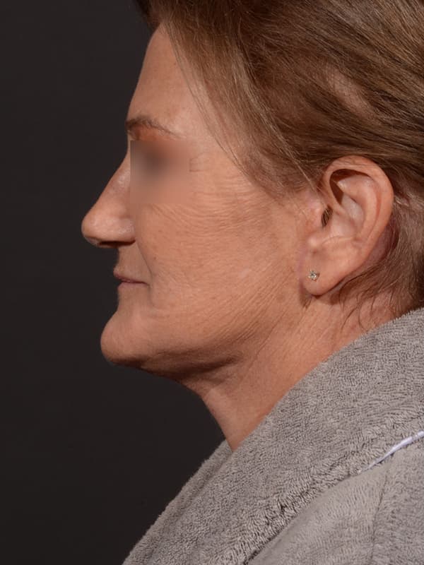 Face and Neck Lift Before & After Image