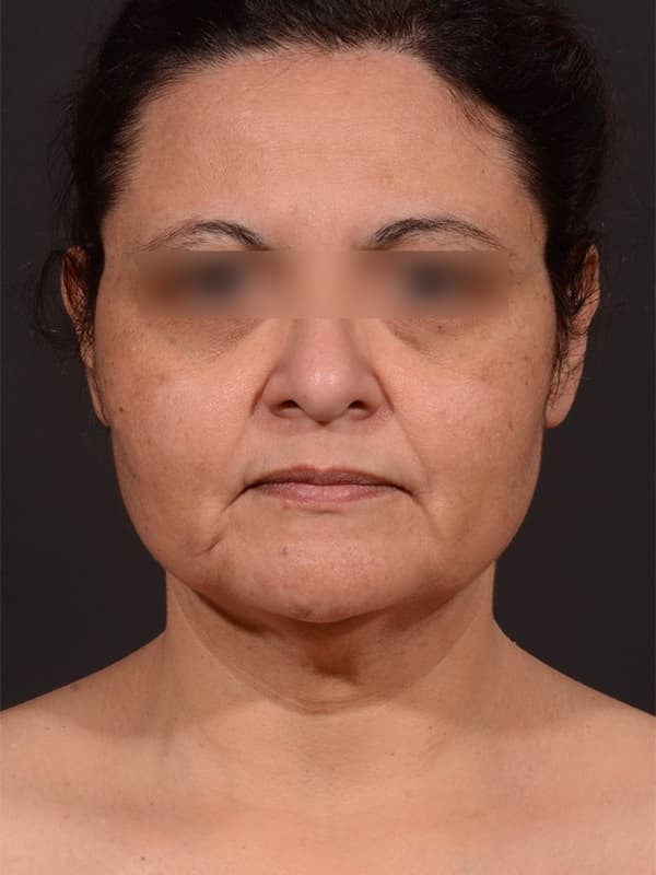 Face and Neck Lift Before & After Image