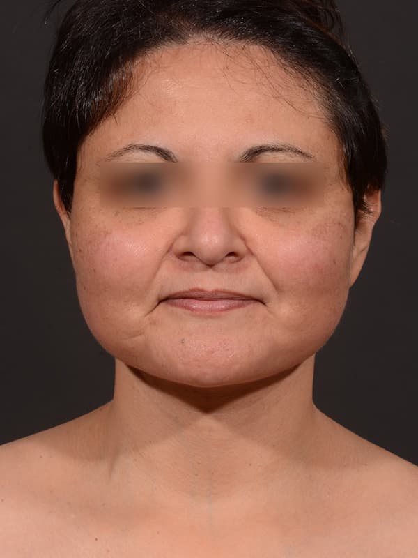Face and Neck Lift Before & After Image