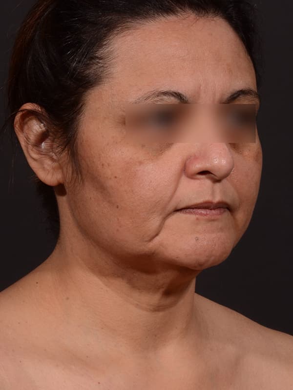 Face and Neck Lift Before & After Image