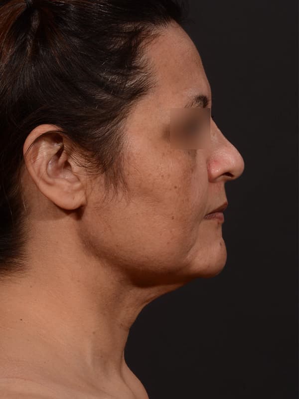 Face and Neck Lift Before & After Image