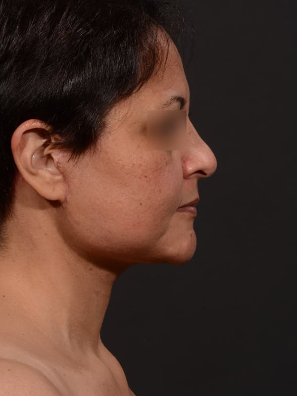 Face and Neck Lift Before & After Image