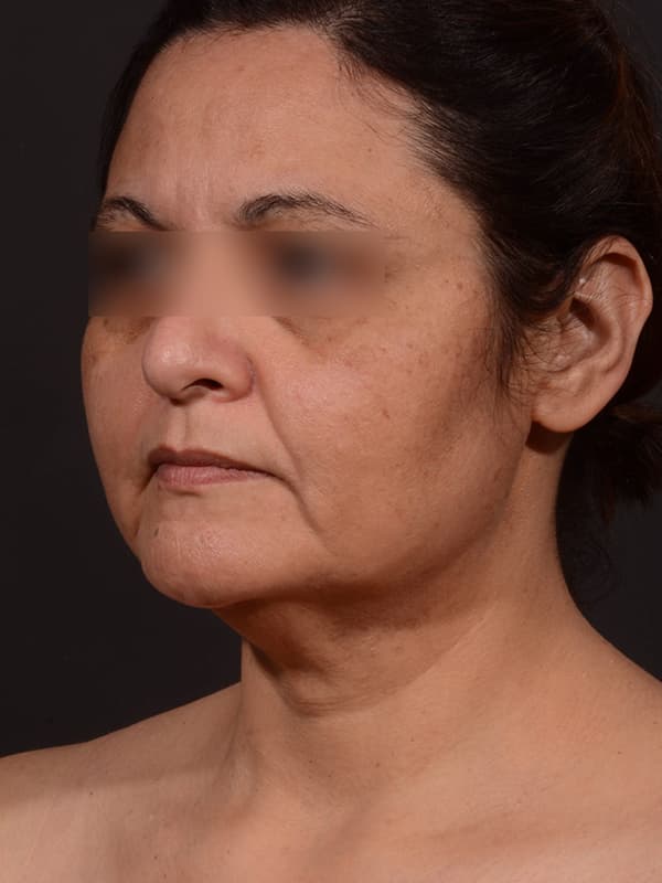 Face and Neck Lift Before & After Image