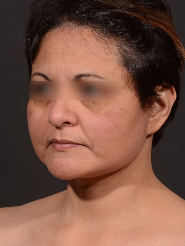 Face and Neck Lift Before & After Image