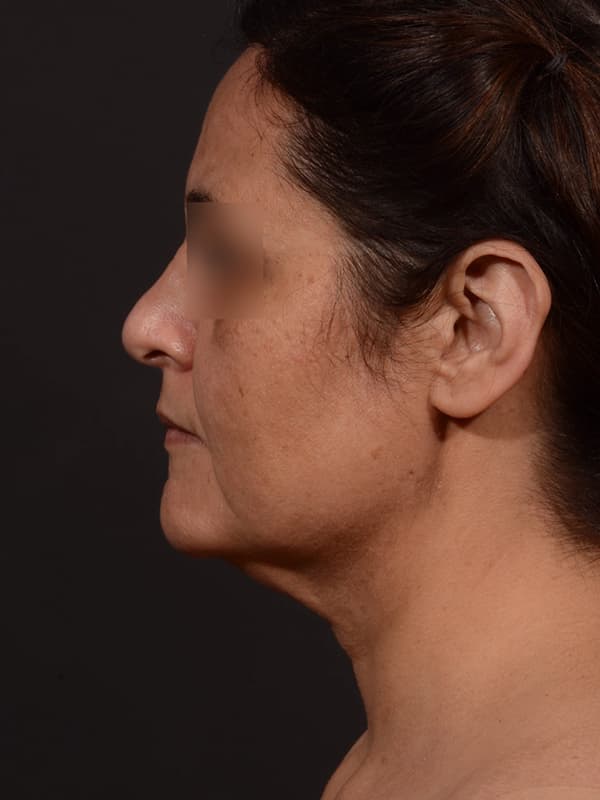 Face and Neck Lift Before & After Image