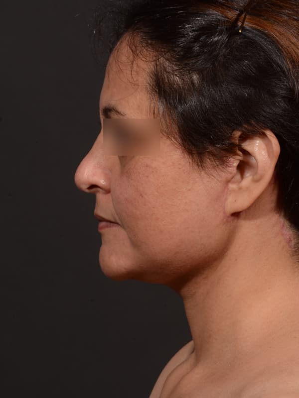 Face and Neck Lift Before & After Image