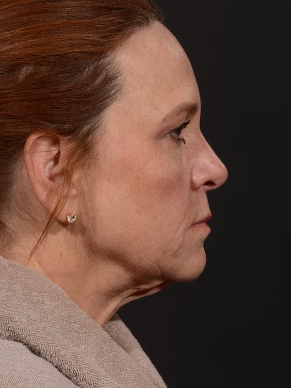 Face and Neck Lift Before & After Image