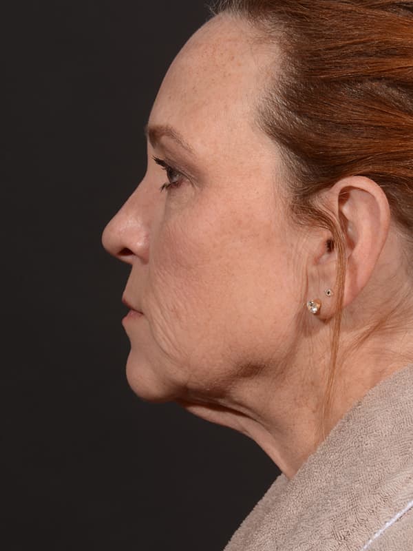 Face and Neck Lift Before & After Image