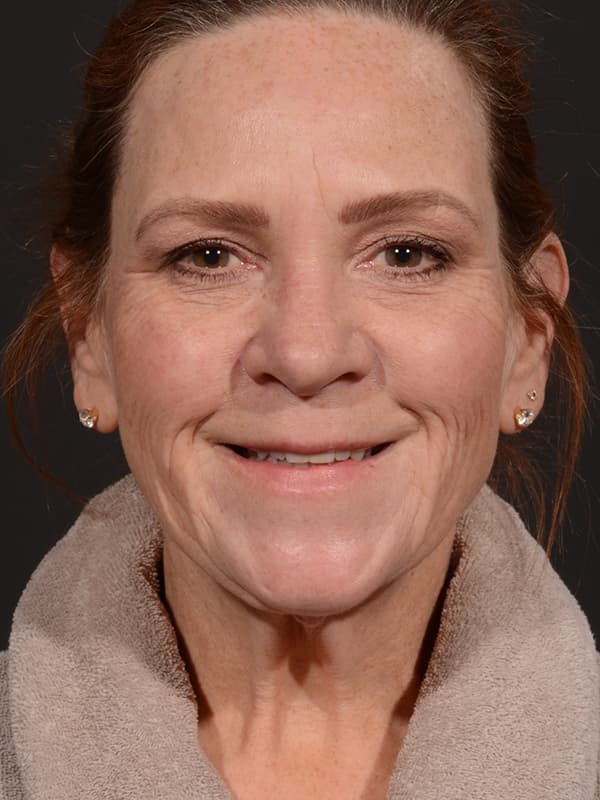 Face and Neck Lift Before & After Image