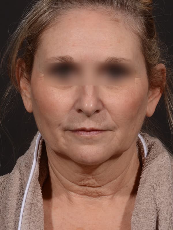 Face and Neck Lift Before & After Image