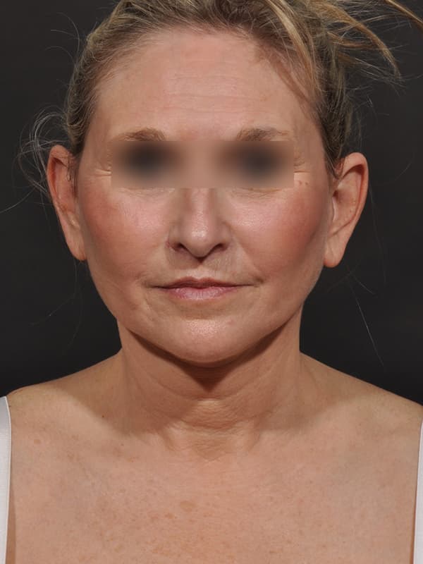 Face and Neck Lift Before & After Image