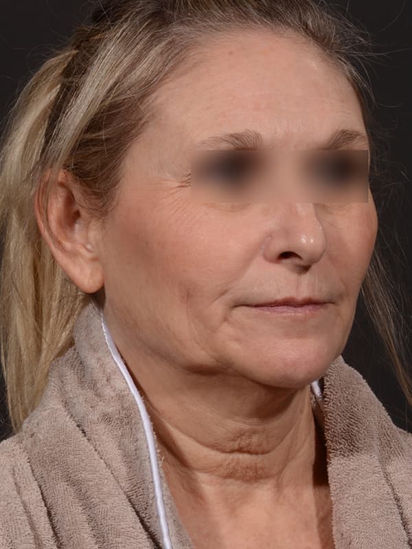 Face and Neck Lift Before & After Image