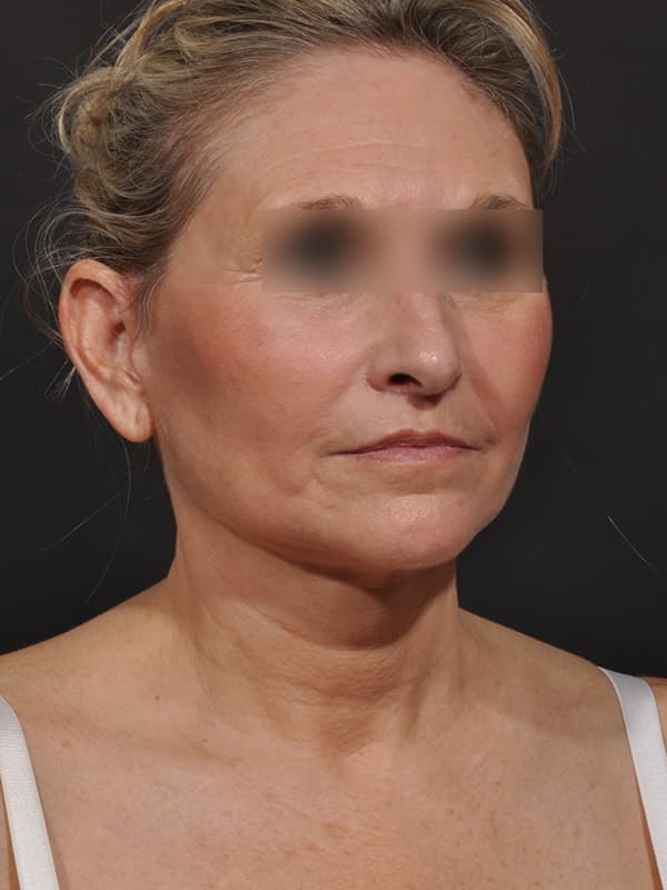 Face and Neck Lift Before & After Image