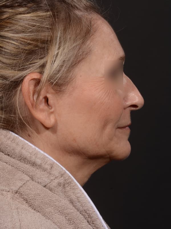 Face and Neck Lift Before & After Image