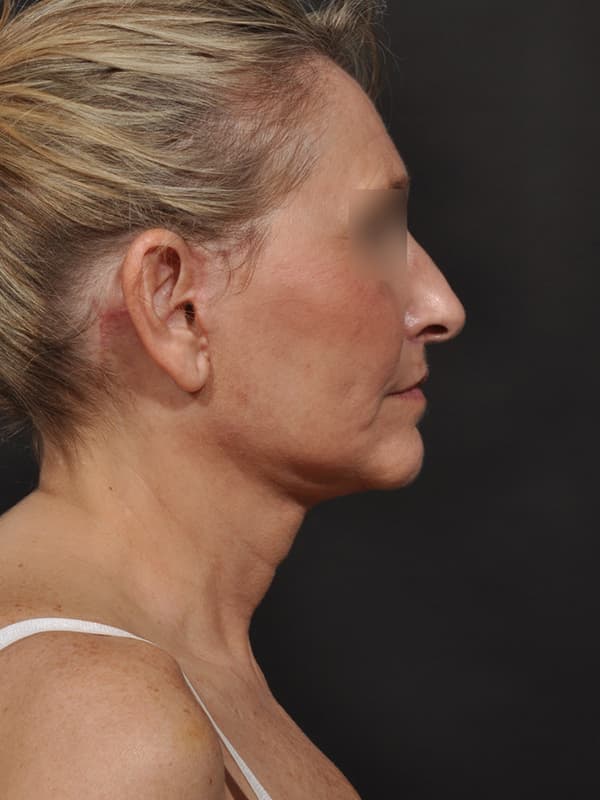 Face and Neck Lift Before & After Image