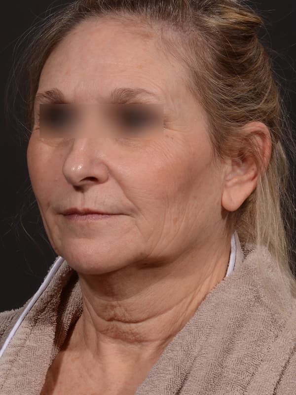 Face and Neck Lift Before & After Image