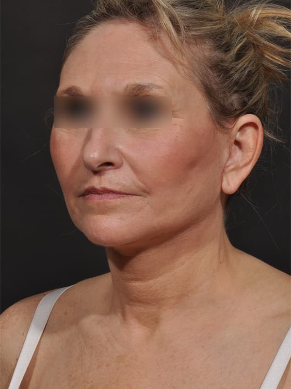 Face and Neck Lift Before & After Image