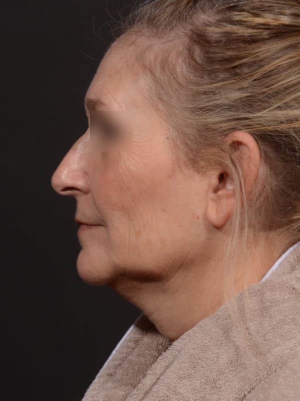 Face and Neck Lift Before & After Image