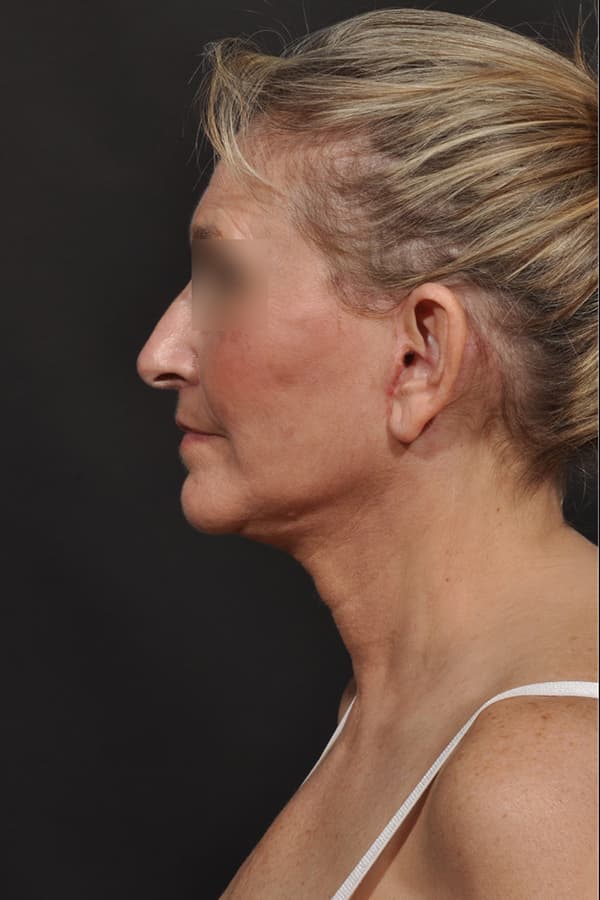 Face and Neck Lift Before & After Image