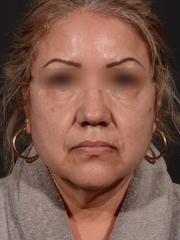 Face and Neck Lift Before & After Image