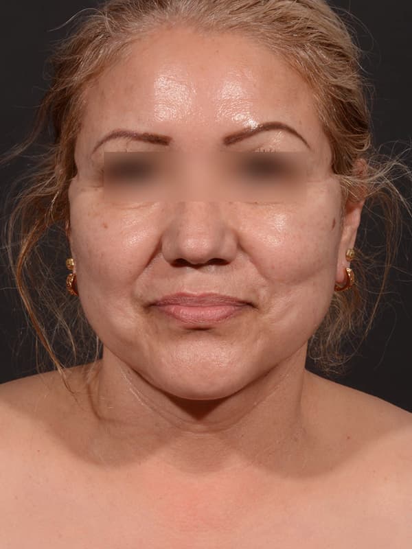 Face and Neck Lift Before & After Image