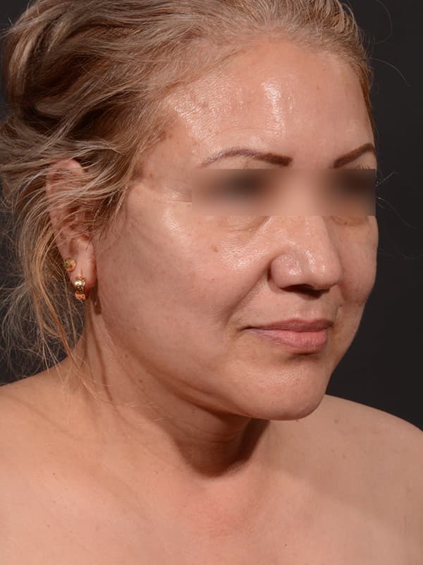 Face and Neck Lift Before & After Image