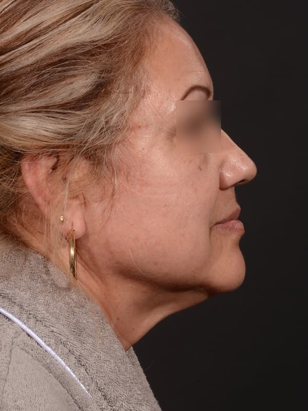 Face and Neck Lift Before & After Image