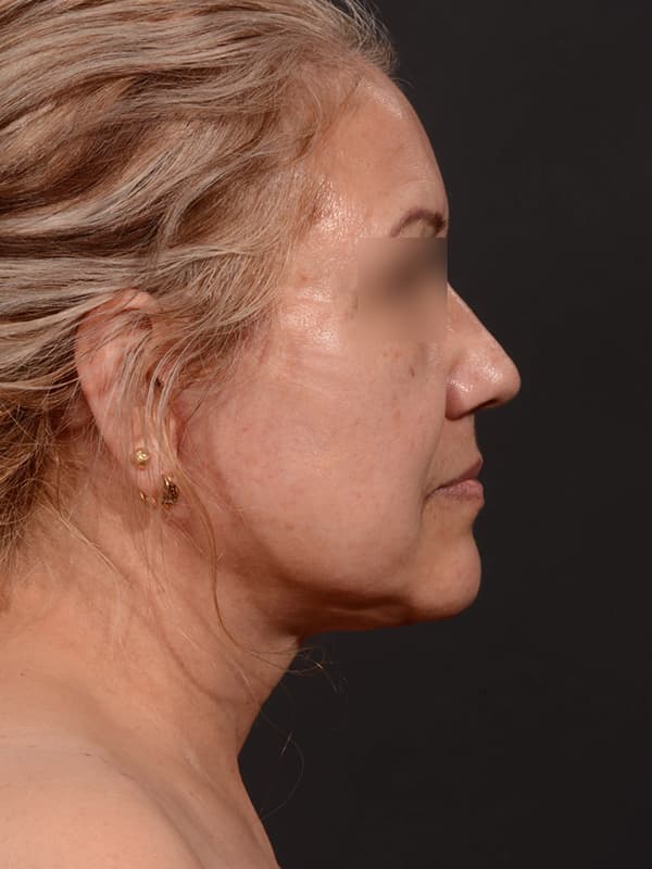 Face and Neck Lift Before & After Image