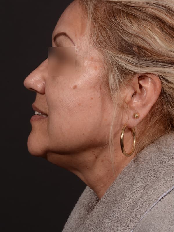 Face and Neck Lift Before & After Image