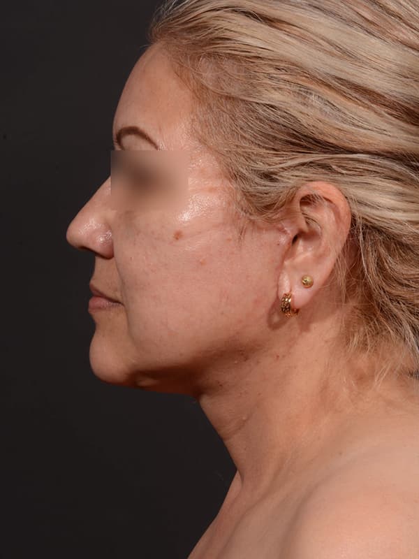 Face and Neck Lift Before & After Image