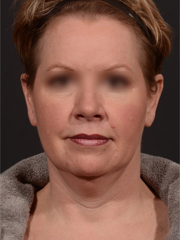 Face and Neck Lift Before & After Image