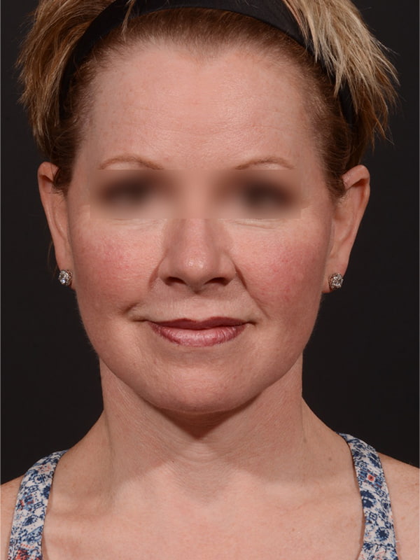 Face and Neck Lift Before & After Image