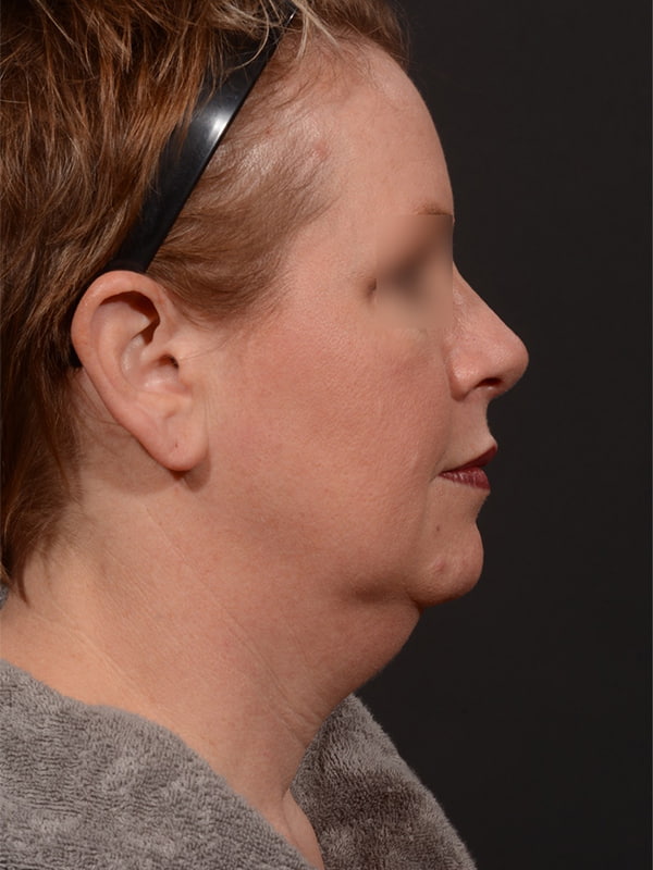 Face and Neck Lift Before & After Image