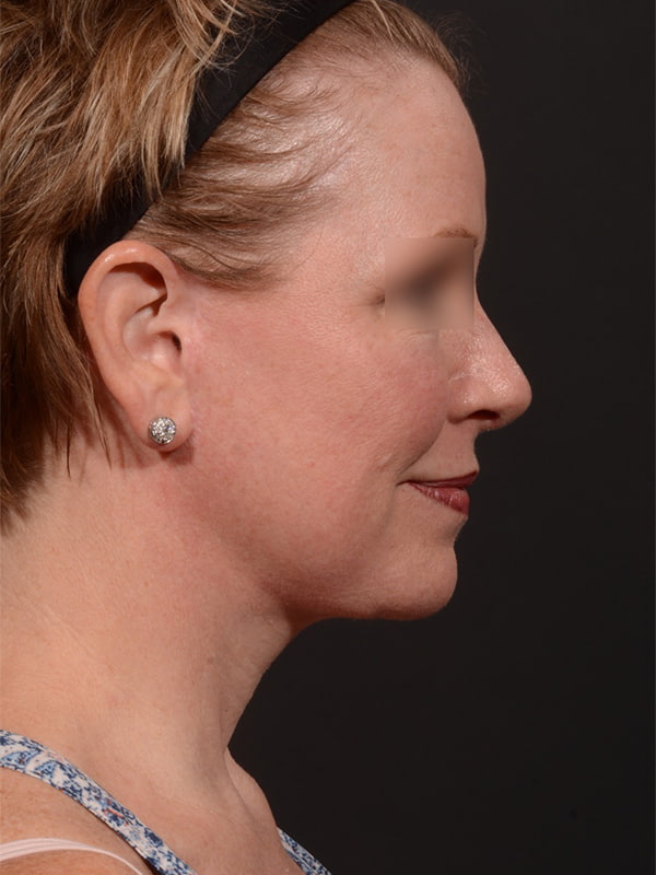 Face and Neck Lift Before & After Image