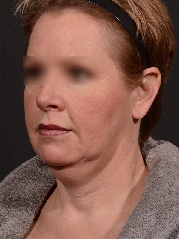 Face and Neck Lift Before & After Image