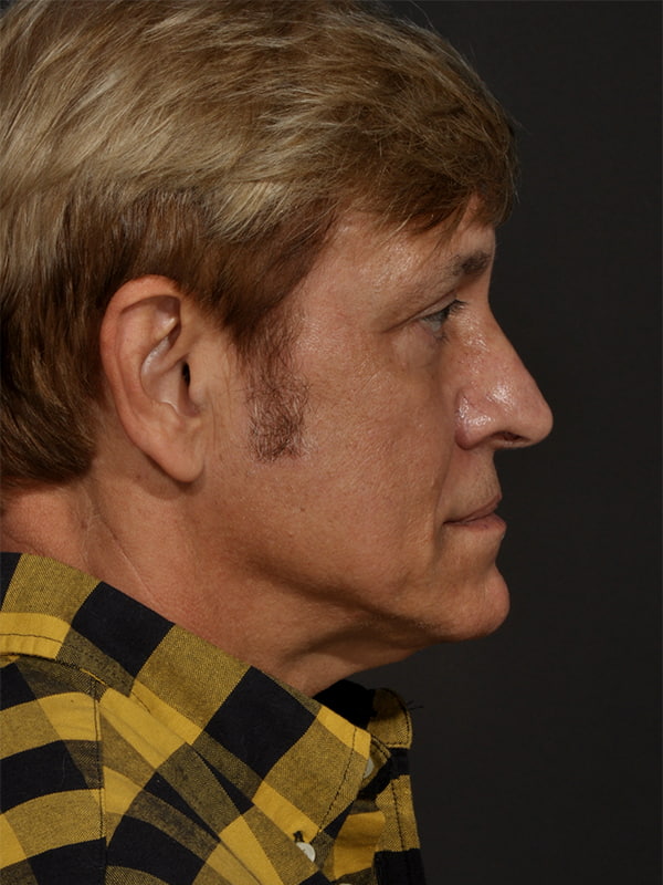 Face and Neck Lift Before & After Image