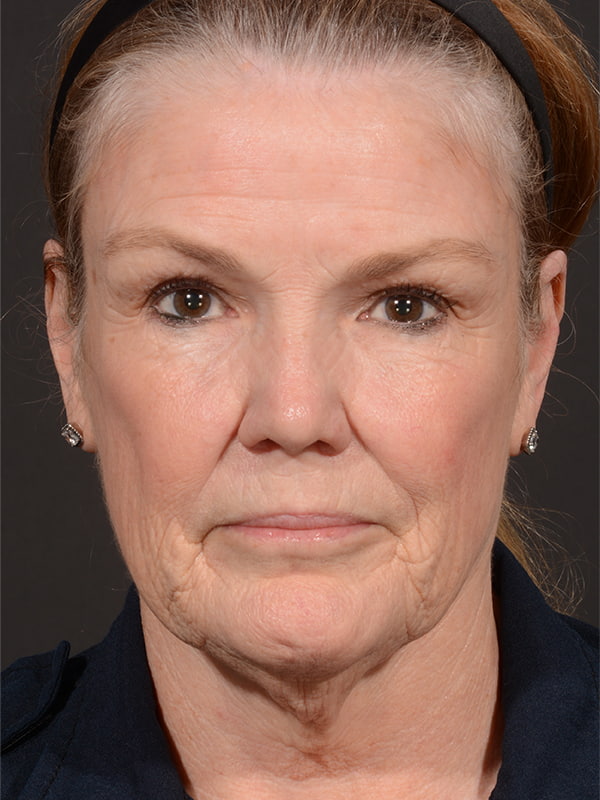 Face and Neck Lift Before & After Image