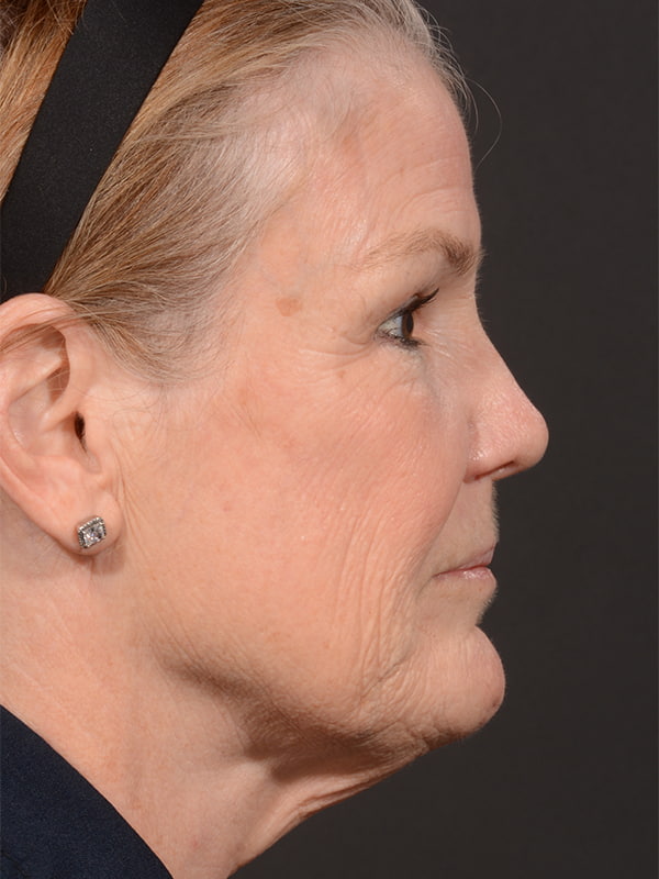 Face and Neck Lift Before & After Image