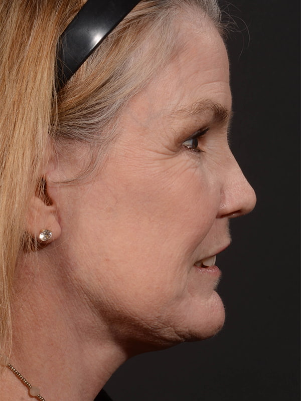 Face and Neck Lift Before & After Image