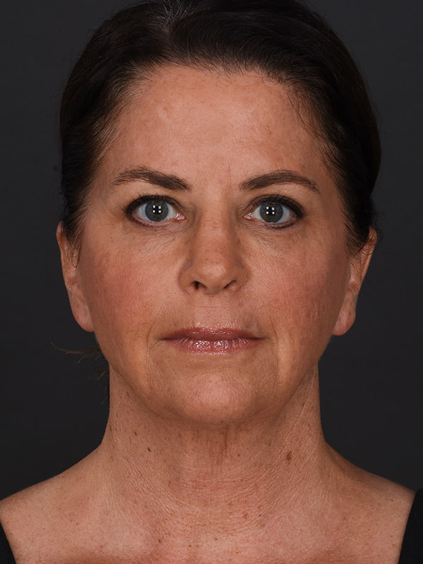 Face and Neck Lift Before & After Image