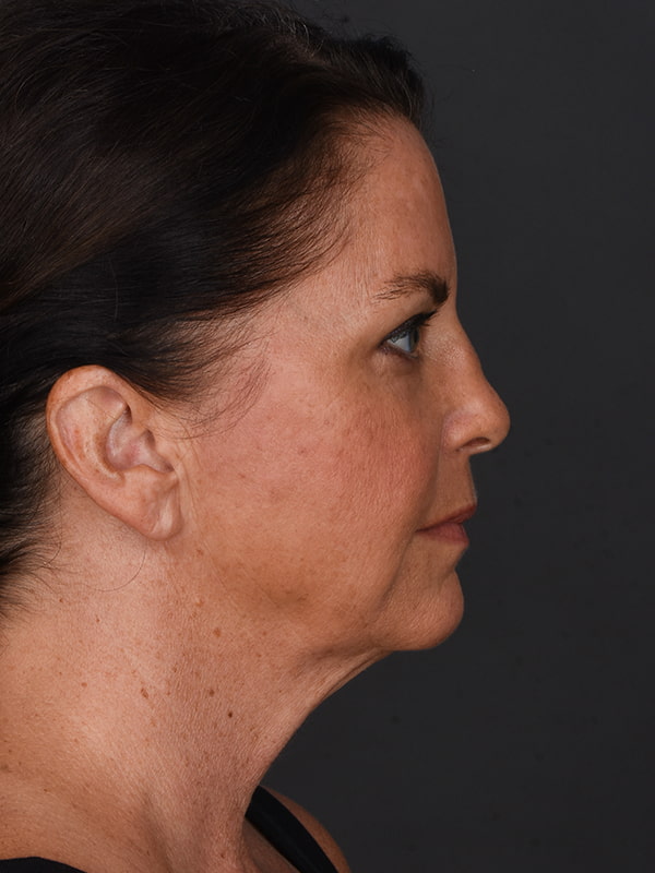 Face and Neck Lift Before & After Image