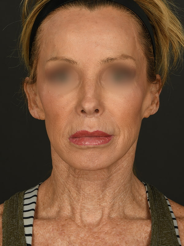 Face and Neck Lift Before & After Image