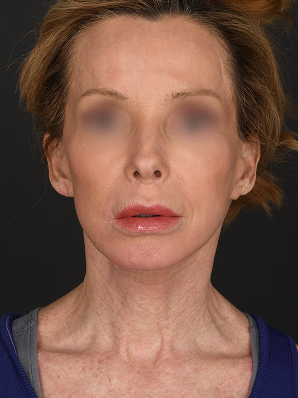 Face and Neck Lift Before & After Image